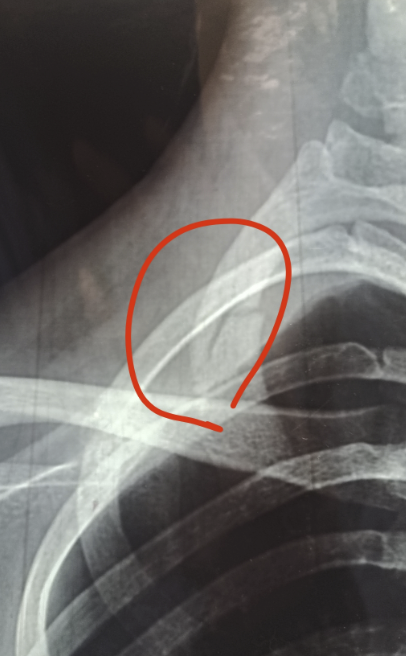 字母圈“脆皮M”有多容易坏掉? 字母圈“脆皮M”有多容易坏掉?